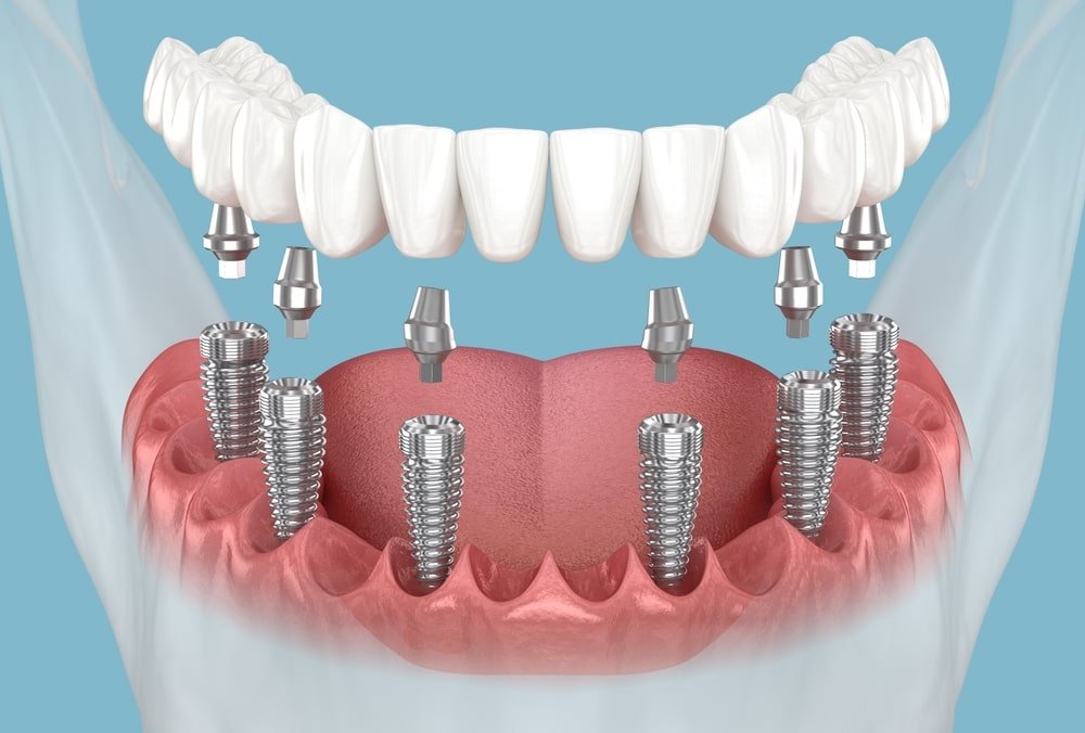 Prothese_dentaire_sur_implants_Laval